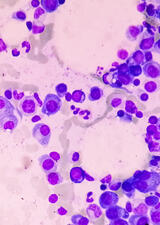 Myeloma